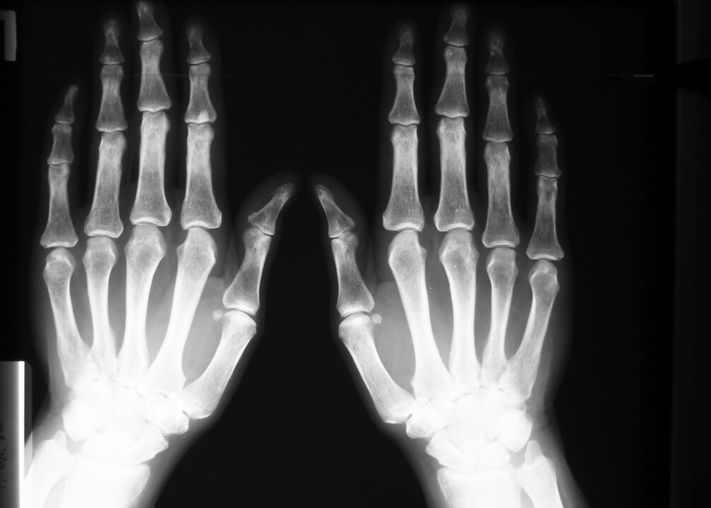 Radiografía para diagnosticar el dolor en las articulaciones de los dedos.
