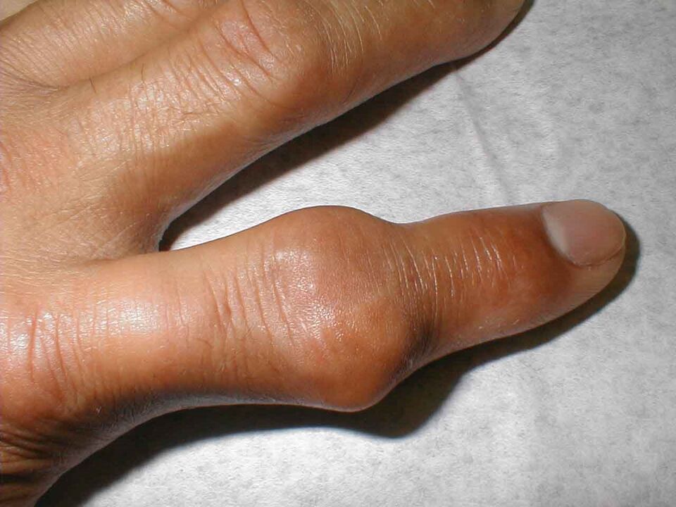 tofos en la articulación del dedo como causa de dolor